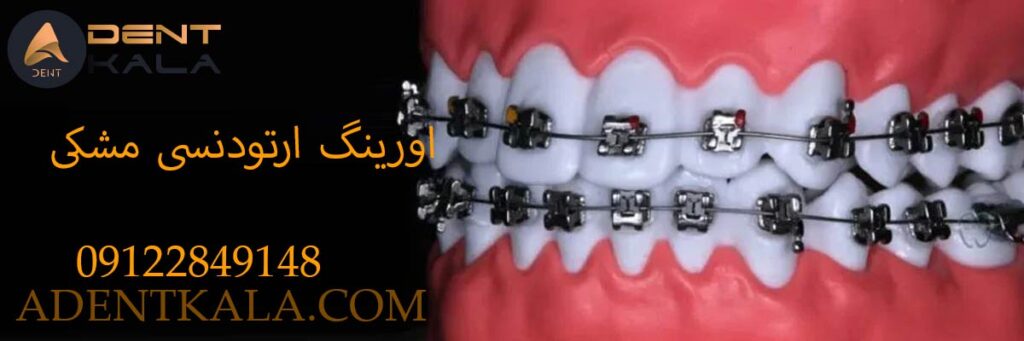 اورینگ ارتودنسی مشکی