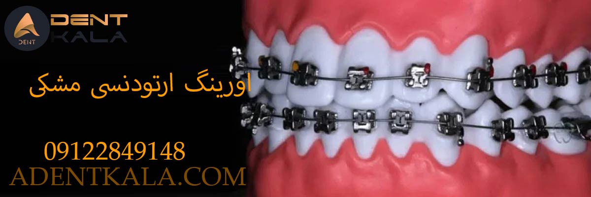 اورینگ ارتودنسی مشکی