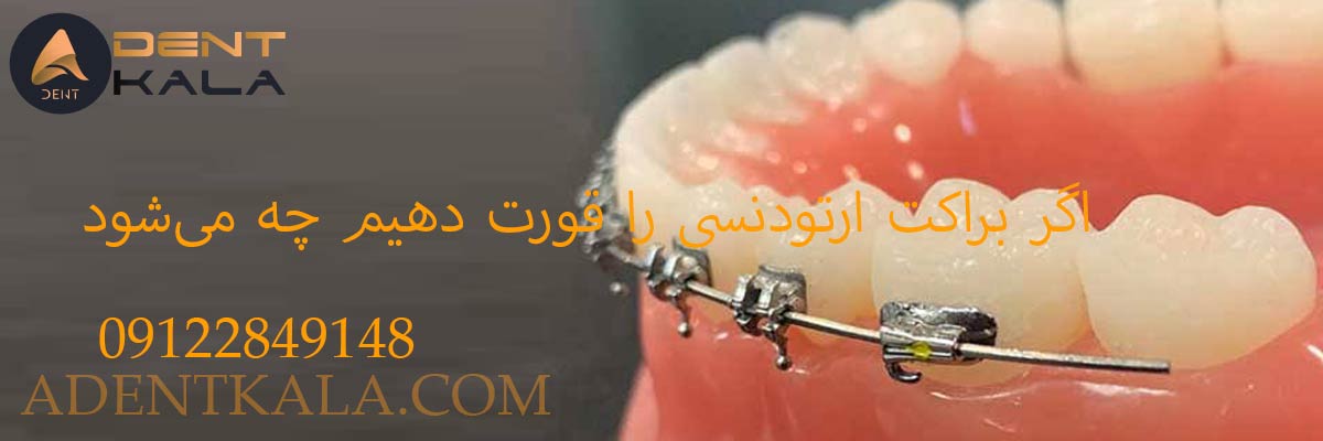 اگر براکت ارتودنسی را قورت دهیم چه می‌شود